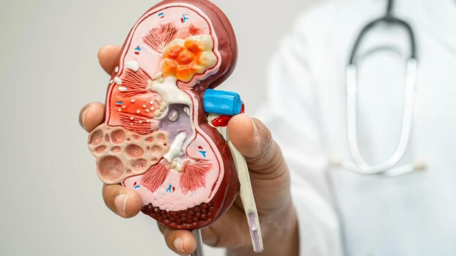 Abordaje integral del edema renal en CDMX