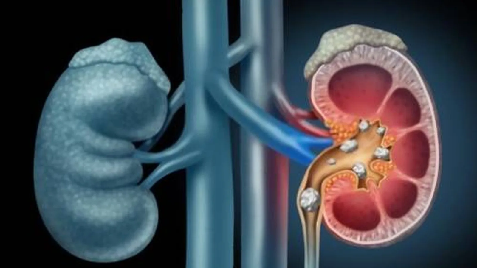 Pielonefritis y salud renal integral en CDMX
