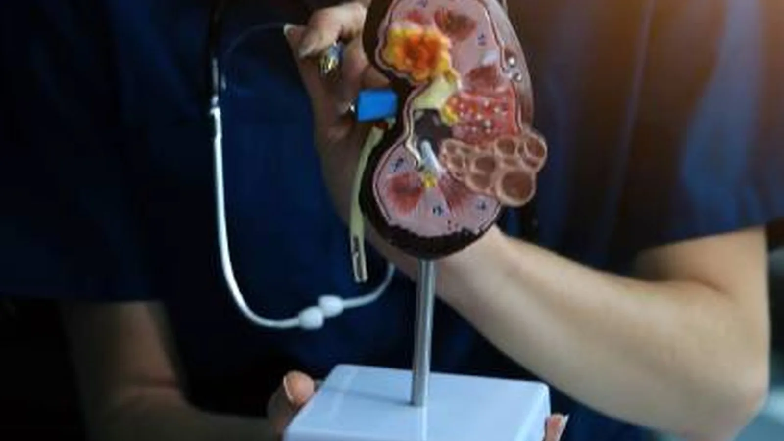 Abordaje integral del síndrome nefrótico en CDMX